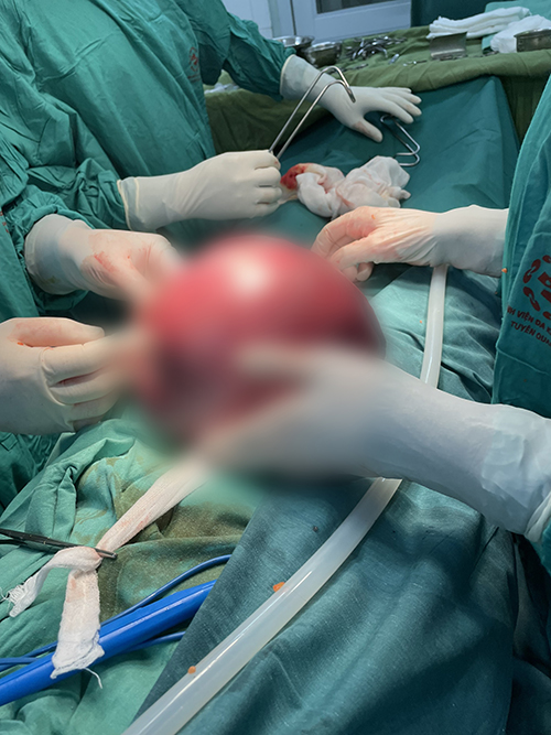 Phẫu thuật thành công khối u xơ tử cung khổng lồ nặng hơn 3kg